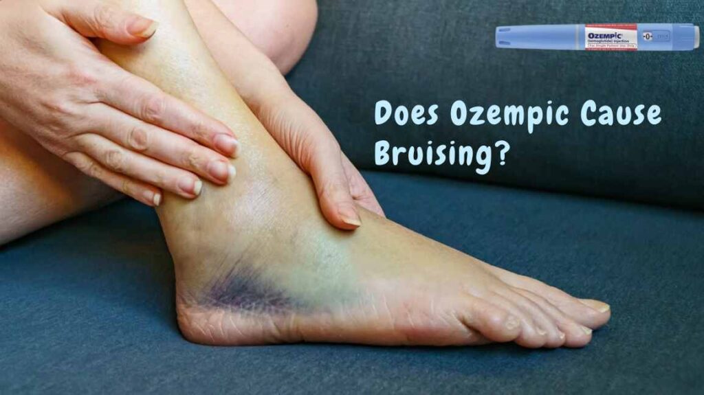 Does Ozempic Cause Bruising? Discover the Truth